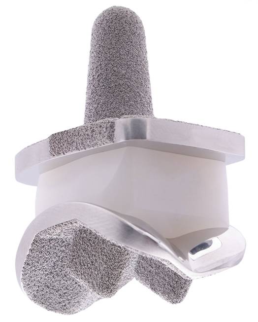 Künstliches Sprunggelenk -    OSG Prothese vom Typ Mobility